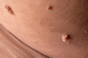 Skin Tag Removal